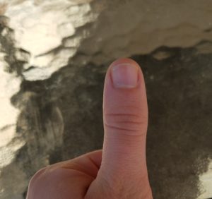 Normal thumb